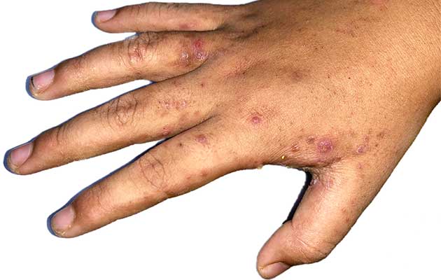 Hautausschlag bei Krätze auf der Hand